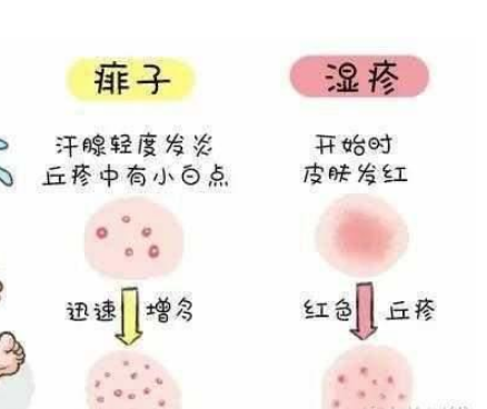 五个月宝宝湿疹，成因、护理与应对策略